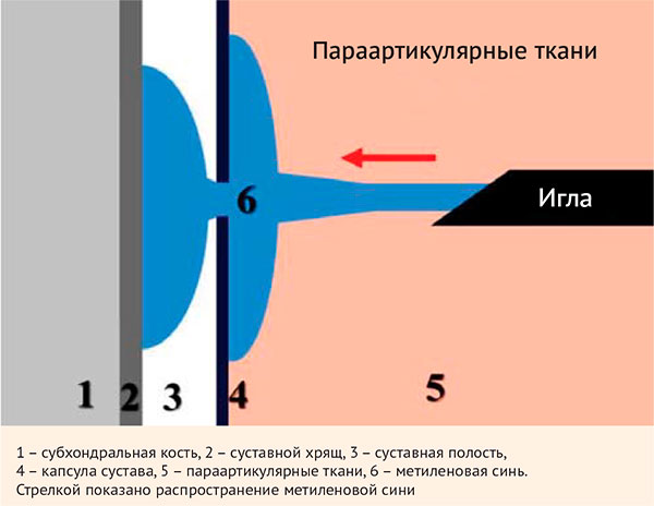 Рисунок 2. Схема интра- и параартикулярного распространения препарата при игольно-струйной инъекции аппаратом «ИСИ-1»