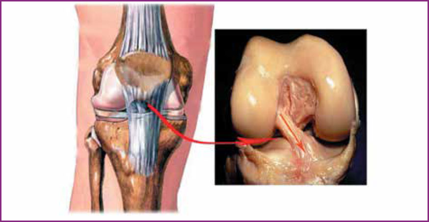 Рисунок 1. Вид передней крестообразной связки коленного сустава