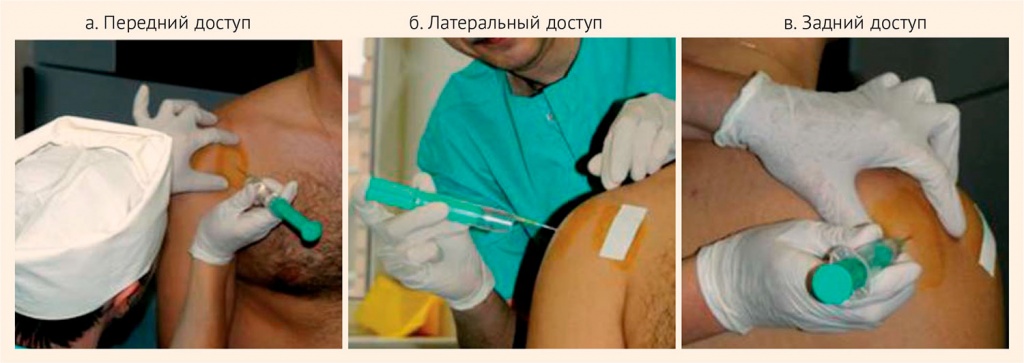 Рисунок 4. Методика перифокальных инъекций в параартикулярные ткани плечевого сустава