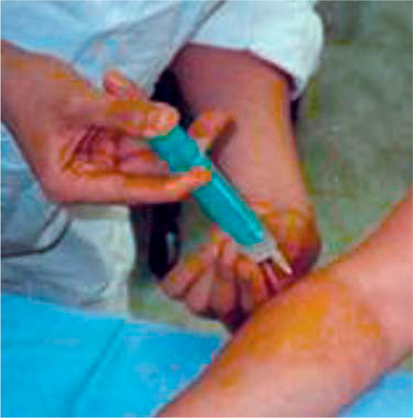 Рисунок 6. Методика перифокальных инъекций в мягкие ткани области локтевого эпикондилита
