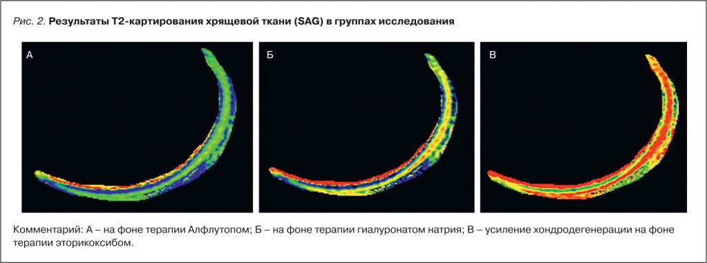 Рис. 2. Результаты Т2-картирования хрящевой ткани (SAG) в группах исследования
