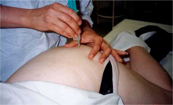 Рисунок 10. Методика перифокальных инъекций в область большого вертела бедренной кости